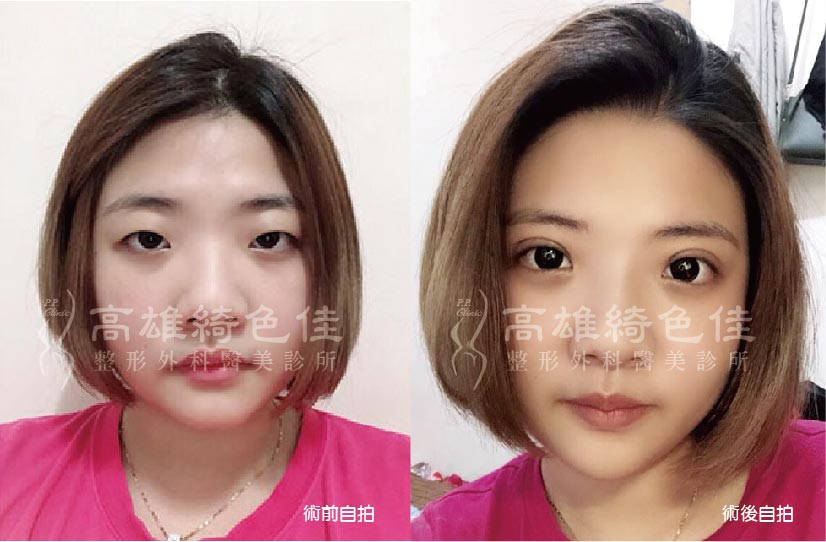 雙眼皮