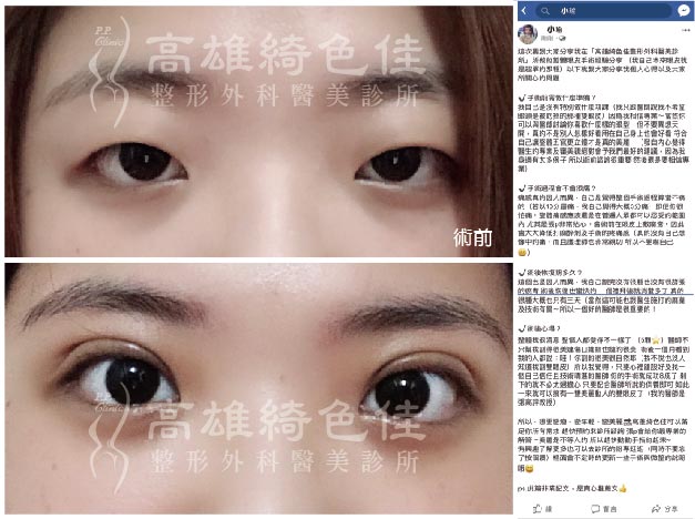 雙眼皮