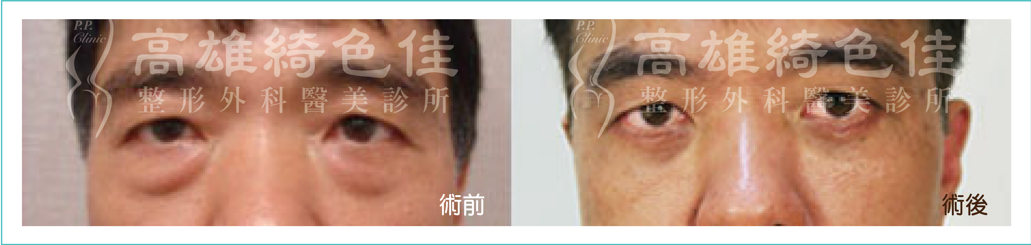 眼袋
