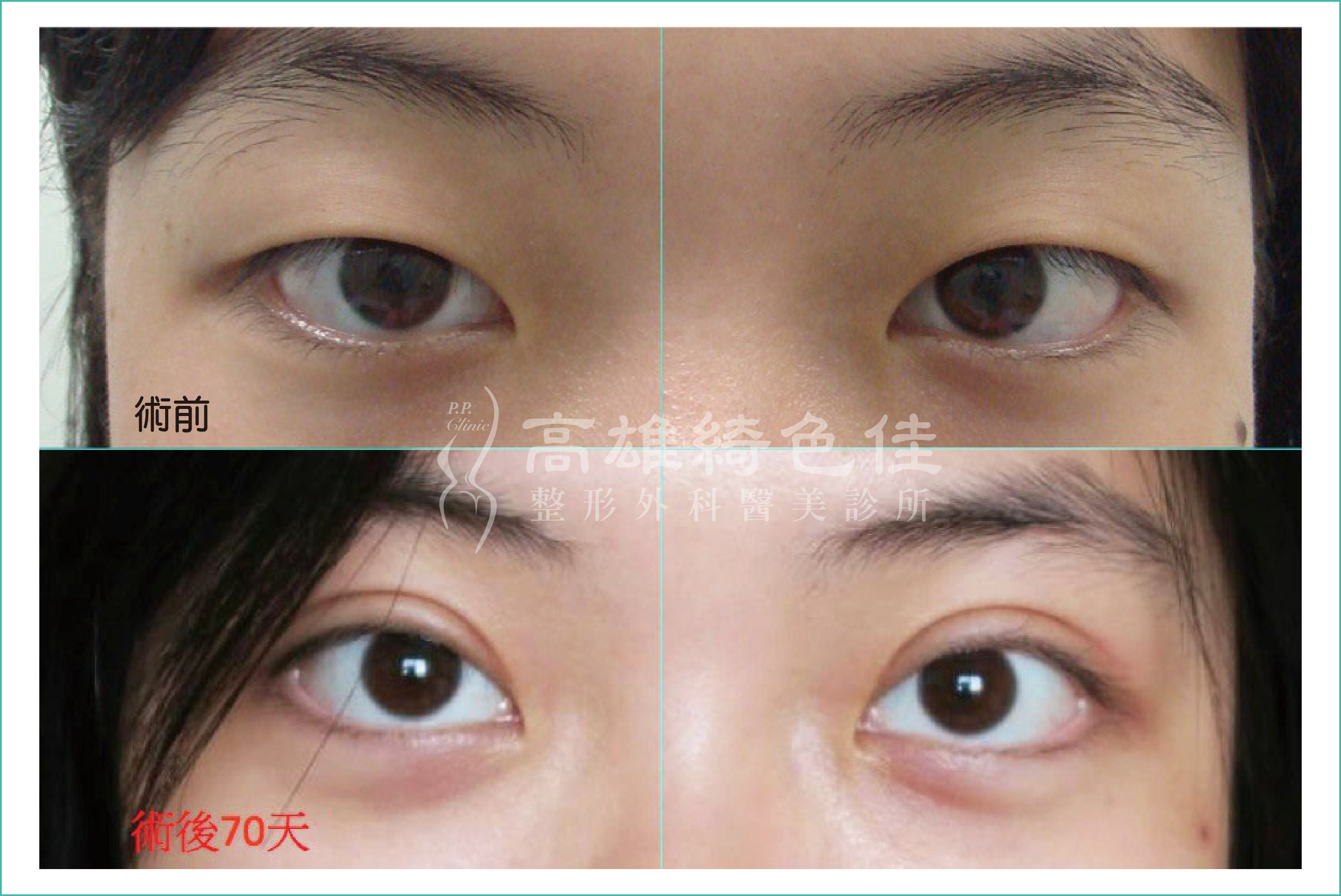 雙眼皮