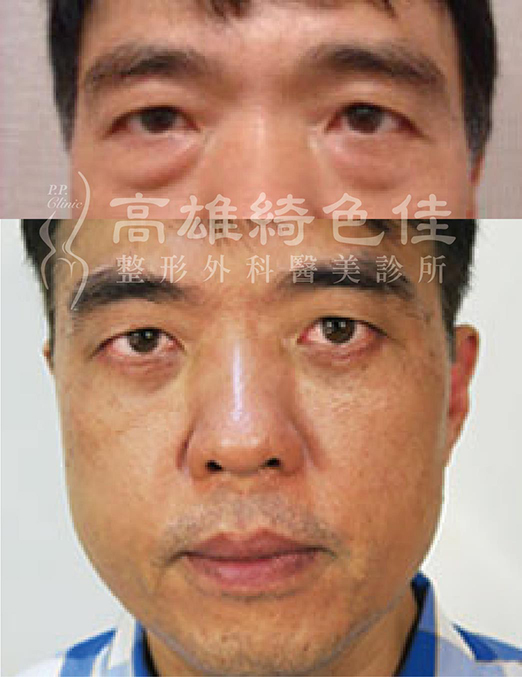 眼袋
