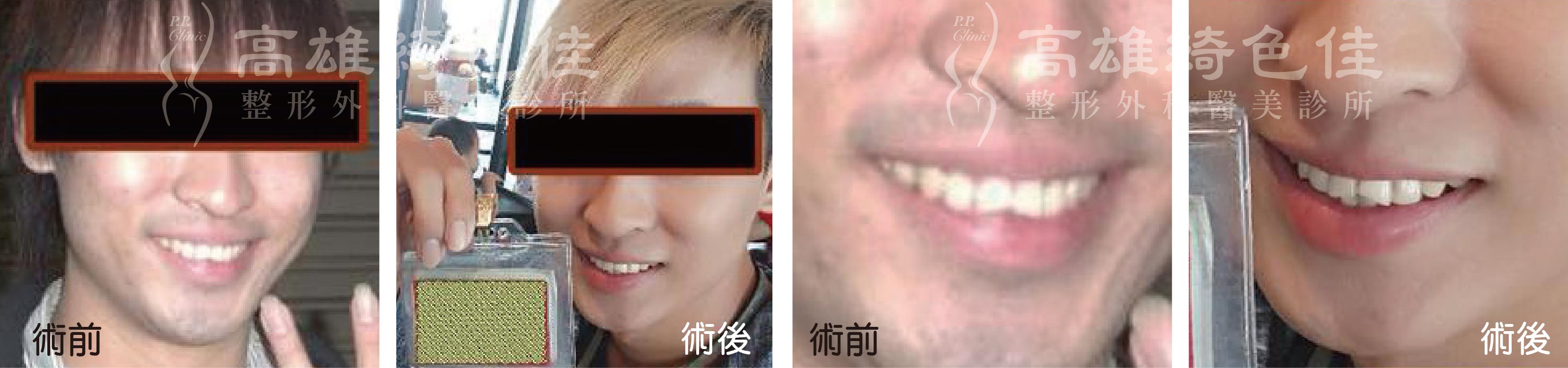 除毛