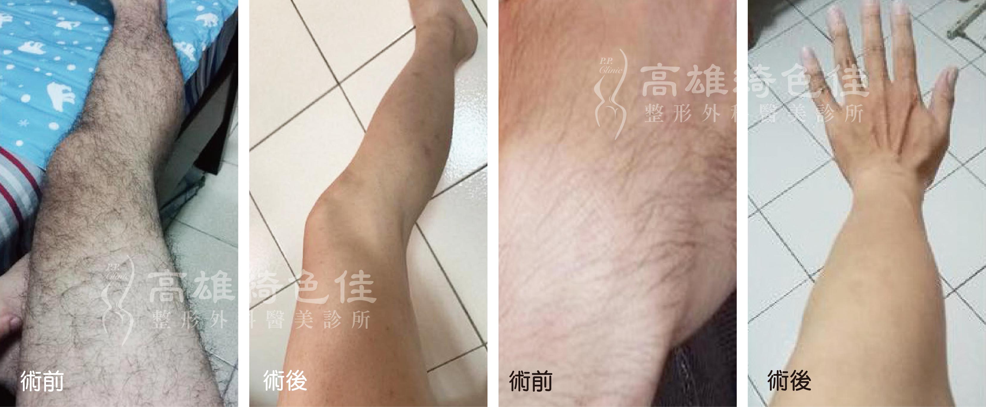 除毛